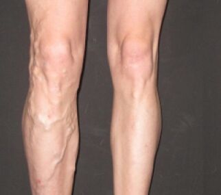 Varicose veins progress rapidly