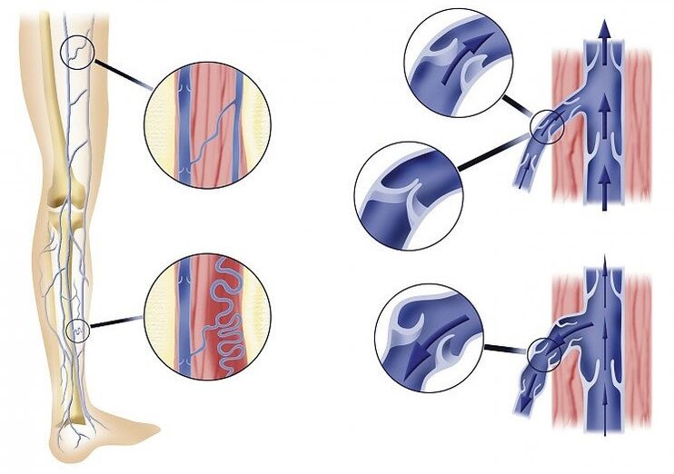 Veniselle restores the blood flow