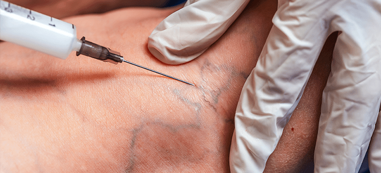 Sclerotherapy is a procedure to eliminate varicose veins