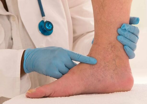 Varicose veins