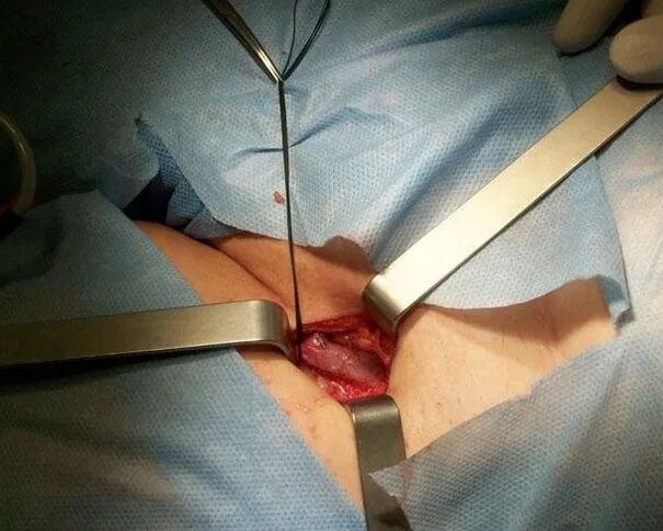 Crossectomy