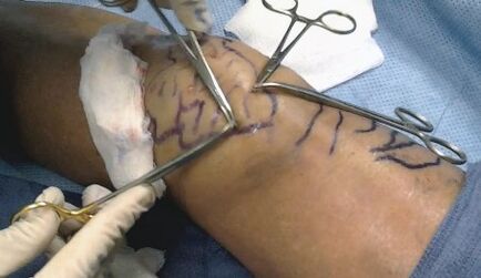 Operation for varicose veins