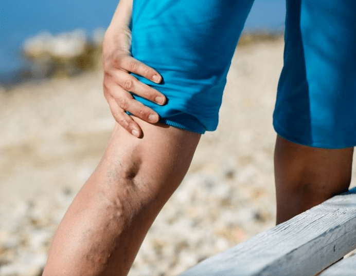 Causes of varicose veins in women