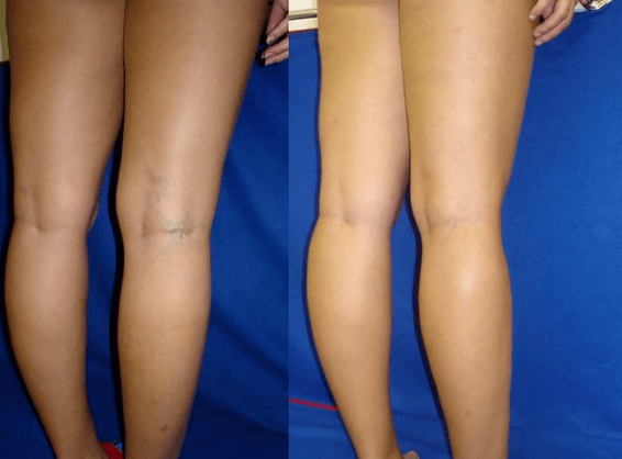 Internal causes of varicose veins