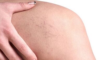 How to manifest varicose veins in women