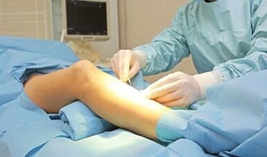 Operating methods for the treatment of varicose veins in women