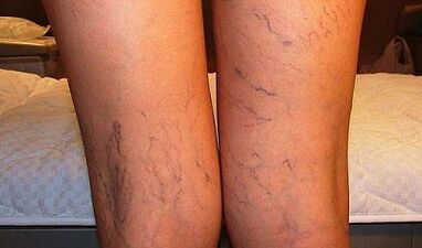 Symptoms of varicose veins in women