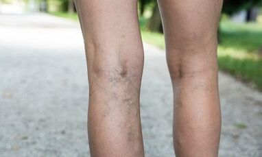 The reasons for the development of varicose veins in women