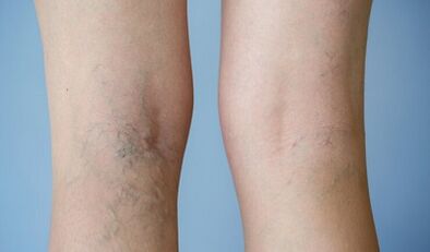 Signs of varicose veins on the legs in women