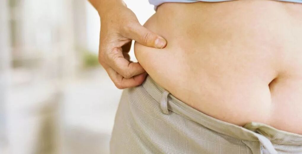 Obesity and varicose veins