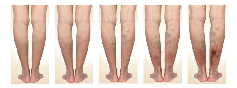 Symptoms of varicose veins