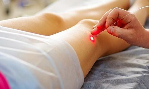 Laser therapy as a method for treating varicose veins