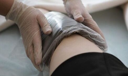 Treatment of varicose veins with compresses