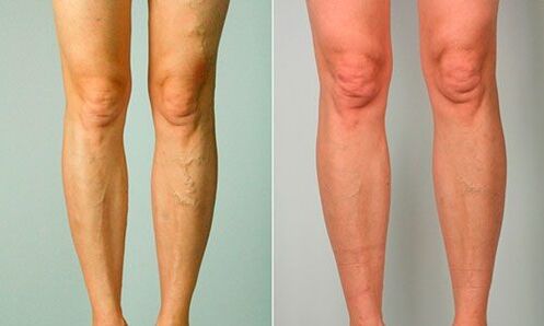 before and after treatment of varicose veins