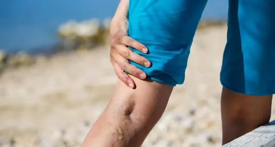 Varicose veins on the legs