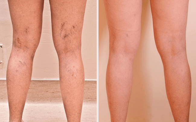 Legs before and after treatment for varicose veins