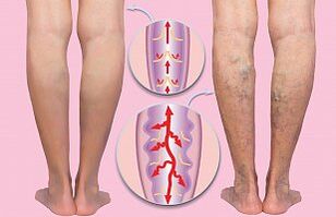 Varicose veins of the lower extremities