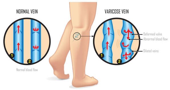 Varicose veins of the lower extremities