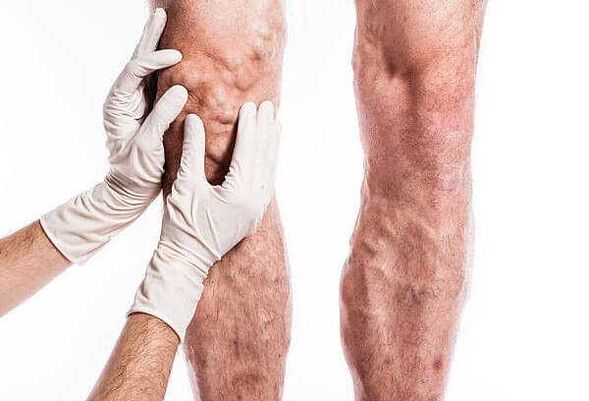 Palpation of varicose veins on the legs
