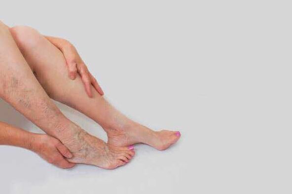 Protruding dilated veins are a sign of varicose veins in the lower extremities
