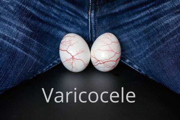 Varicocele – enlargement of the spermatic cord veins