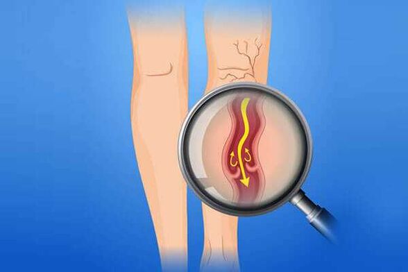 Venous valve affected by varicose veins
